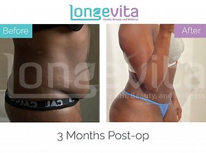 Tummy Tuck Turkey | Full & Mini Abdominoplasty | Longevita