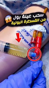 320K views · 3.8K reactions | إزاي تسحب عينة بول بشكل صحيح؟ Urine Sample from Catheter 喙 #تمريض #عينات #UrineSample #قسطرة #نصايح_تمريضية #تمريض_مصري #ممرضين #تمريض_عملي #NursingTips #ClinicalSkills #عدوى_بولية #InfectionControl #NursingEducation | إيجي نيرسولوجي - EgyNursology | Facebook