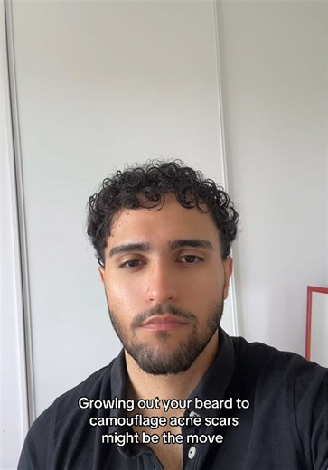 Camouflaging Acne Scars with Beard Growth