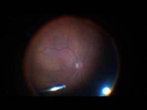 23G PPV with ERM/ILM peeling. Staining with Alchemia DUAL die Lukan Mishev Live Stream