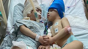 Brazilian conjoined twins separated after 27 hours of surgery