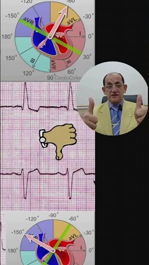 HOW TO INTERPRET ECG (26)