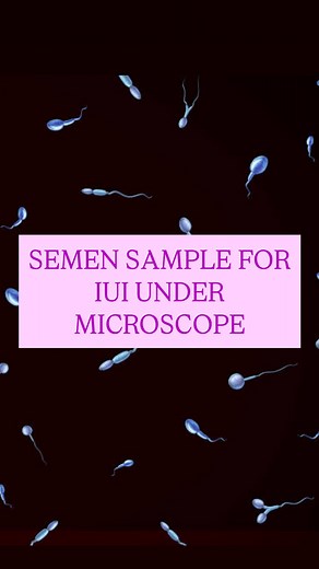 5.8K views · 91 reactions | When is IUI used? ✅ Unexplained...
