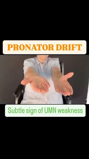 Rahul Rajeev on Instagram: "CLINICAL SIGN - PRONATOR DRIFT (Barre’s sign) - Subtle sign of UMN lesion Patient is asked to hold both the upper limbs outstretched, symmetrically in front with the palms facing upwards (supinated) and then asked to close both eyes tightly.Watch for the position of weak limb. The weak limb pronates and drifts down. Reason - In corticospinal tract lesion, the selectively weakened muscles are shoulder abductors, external rotators, supinators and elbow extensors. So, th