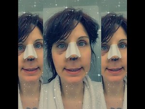 Septoplasty / Rhinoplasty Cast Stitches Stent Removal 5 Days After Surgery *graphic*