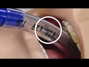 Avanos® Turbo Cleaning Closed Suction Catheter System