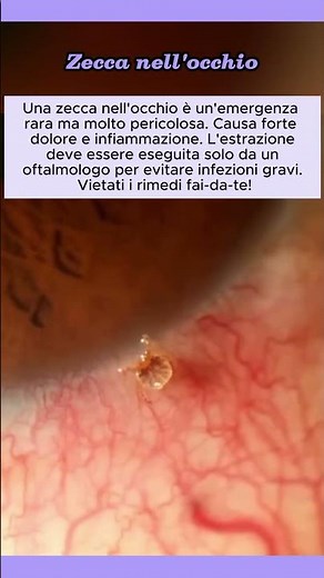 Zecca nell'occhio