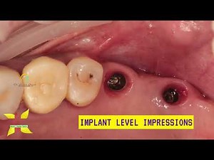 Direct sinus lift with dental implants and bone grafting