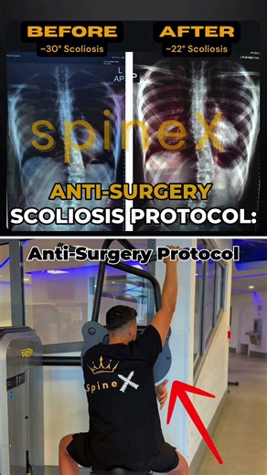 This Is Why Scoliosis Never Improves