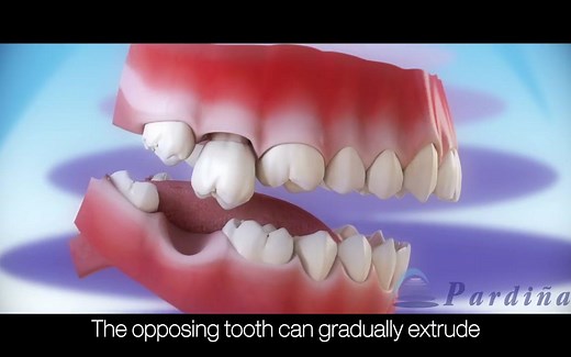 【科普缺失牙】原来缺少一颗牙齿的情况这么严重