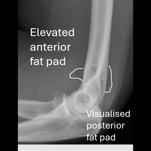 Radial head fracture causing elbow joint effusion