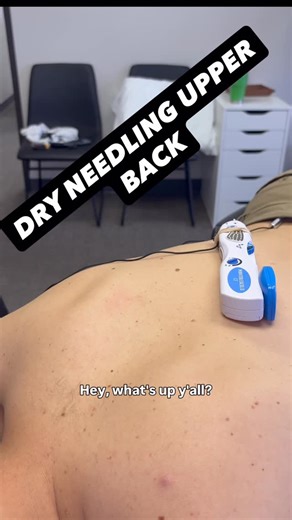Reactiv Sport and Spine on Instagram: "DRY NEEDLING LOWER TRAPEZIUS This is a typical dry needling experience at Reactiv Sport and Spine. In this dry needling video, the lower trapezius muscle is getting worked on. Trigger points in this muscle cause pain in the shoulder blade area and also up into the neck. Trigger points in this muscle are common with people who work/sit at a desk all day. #chiro #healthandwellness #health #exercise #dryneedling"