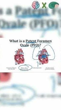 What is a patent foramen ovale (PFO)? #chronicillness #science #occipitalneuralgia #migraine #step1