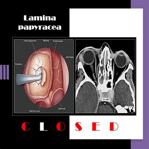 Nose radiology series (15); The lamina papyracea (11) #shorts