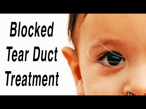 Blocked Tear Duct Surgical Correction Animation