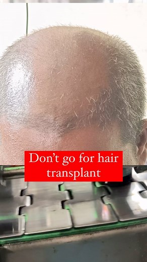 I have made a natural DHT blocker oil with 150 herbs 🌿 Hair loss got you stressed? We get it. But before you start researching expensive procedures, unlock the wisdom of ancient Ayurveda with Keshpallav hair oil. Our powerful, all-natural formula is packed with DHT-fighting heroes like Bhringraj and Rosemary Oil. These work together to: 1. Prevent DHT from sticking to hair follicles 2. Strengthen hair follicles 3. Promote healthy hair growth Nanaji’s Keshpallav Hair Oil is also now scientifical