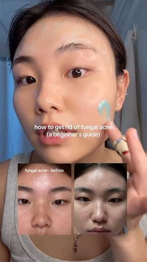 gina ౨ৎ on Instagram: "if you’re still dealing with fungal acne, this is my CHEAT CODE: 1. nizoral shampoo as face mask (any shampoo with ketoconazole 1%) 2. mild daily exfoliation: i.e. @houseofhur_official clearing essence pads 3. check all other products to make sure FA safe on sezia.co or www.sofiepavittface.com/pages/pore-clogging-ingredients by @sofiepavitt @sofiepavittface !! #fungalacne #fungalacnesafe #skincareroutine #koreanskincare #nizoral"