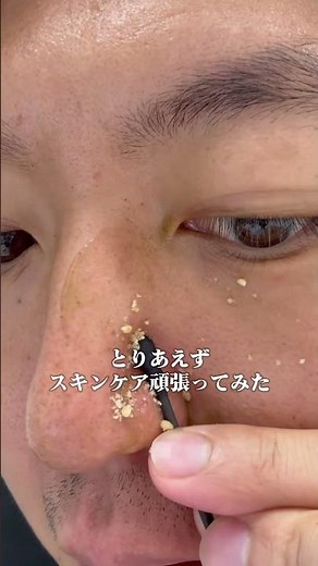 毛穴が汚すぎたから本気でスキンケアやってみた!!on:myskinおすすめ🌿#美容 #メンズ美容 #ニキビ#毛穴 #ハーブピーリング pr