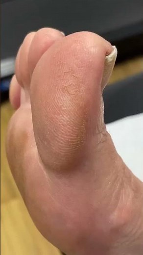 Big Toe Callus Removal: Expert Treatment by Australian Podiatrist