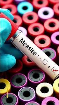 Review Article: Measles 2025