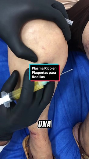 Colocación de Plasma Rico en Plaquetas para Dolor de Rodillas