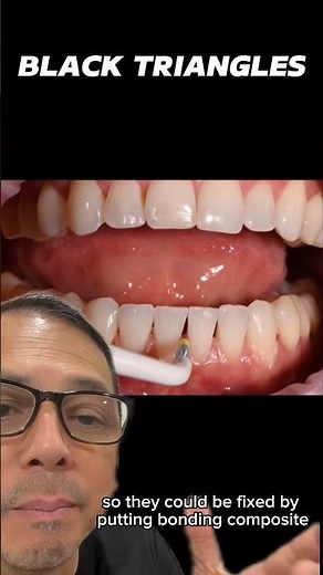 Filling Black Triangles with Resin Composite | In Office to Hands On Dental Training #shorts