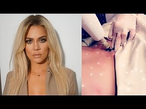Khloe Kardashian Documents The Removal Of Her 'Tramp Stamp'