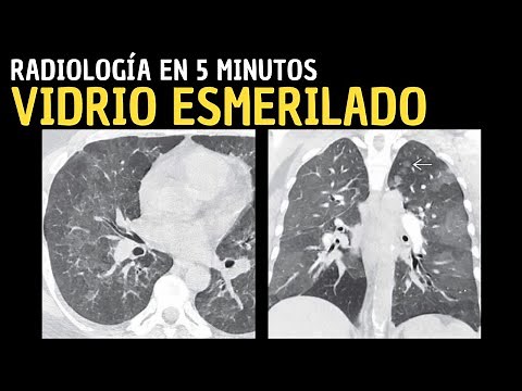 Pulmonary radiological signs: Ground glass: Radiology in 5 minutes.