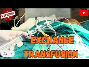 Exchange blood transfusion in newborn baby | 🩸Double volume exchange transfusion procedure
