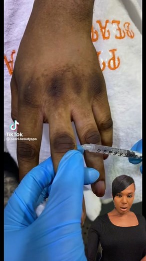 Skin Bleaching: Is It Worth the Risks? Dark Knuckles and Hand Hyperpigmentation