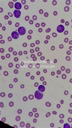 Marilyn | CLS MLS(ASCP) on Instagram: "This is what a child’s blood cancer may look like under the microscope. ALL: Acute Lymphoblastic Leukemia. It’s more than just cells under the microscope; it’s a diagnosis that changes lives. ALL is a cancer of the bone marrow and lymphoid line, where immature white blood cells (lymphoblasts) multiply uncontrollably, crowding out healthy cells that your body needs to function. Under the microscope, you’ll see: Large lymphoblasts with high nuclear-to-cytopla