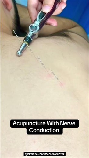Nerve conduction