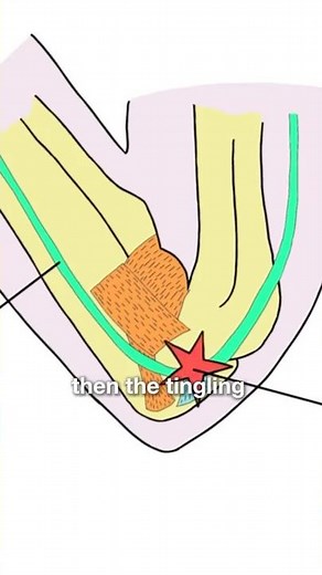 2/6 Cubital Tunnel Syndrome - Symptoms