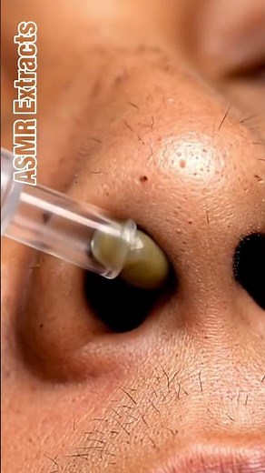 ASMR Extracts | Deep Pore Blackhead