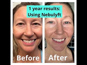 MY AMAZING 1 YEAR RESULTS USING NEBULYFT N1 MIRCO RF ANTI AGING DEVICE: BEFORE AND AFTER