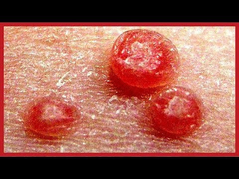 Feigwarzen Behandlung ⏩ 3 lächerlich einfache Schritte um Feigwarzen schnell zu entfernen