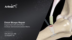 Distal Biceps Repair Augmented with ArthroFlex® Acellular Dermal Extracellular Matrix