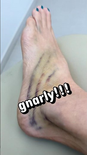 Crazy striped bruising 1 week after rolling my ankle