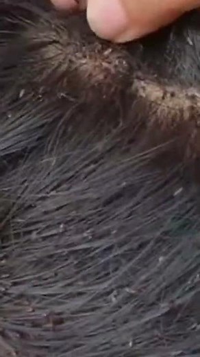Thousand lice combing - Big lice removal