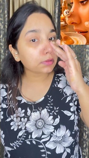 How to Remove Blackheads Safely: Easy Tips for Clear, Healthy Skin ✨🌸 #blackheadremoval #clearskin