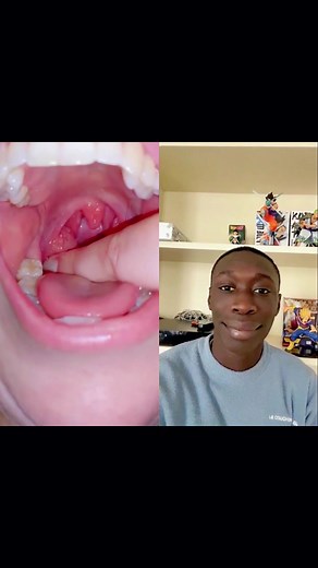 #tooth #teeth #teethcare #toothbrush #teethcleaning #teethtok #teethchallenge #teethfilling #rootcanal #rootcanals #rootcanaltreatment #rootcanalsurgery #rootcanalfilling #rootcanalfiles #rootcanalprocess #rootcanalsupplier #endodontic #endodontics #dental #dentalhygienist #dentalstudent #dentalassistant #dentalschool #dentalhygiene #dentaloffice #dentalist #dentist #fyp #fypシ #foryoupage