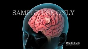 50 reactions · 40 shares | Promote health literacy: please watch & share this animation on Intensity Modulated Radiation Therapy (IMRT). | Nucleus Medical Media | Facebook