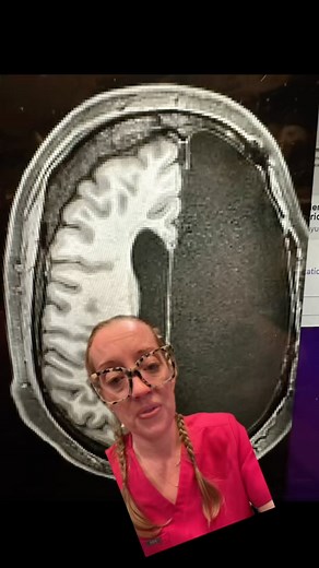 48K views · 1K reactions | What is Rasmussen’s encephalitis? Rasmussen’s encephalitis (RE) is a very rare, chronic inflammatory neurological disease that usually affects only one hemisphere (half) of the brain. It most often occurs in children under the age of 10 but can also affect adolescents and adults. #neurosurgery #casestudy #epilepsy #seizure #pediatrics #pediatricneurosurgery #rasmussensencephalitis | Dr. Betsy Grunch - Ladyspinedoc | Facebook