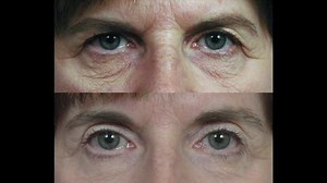 Eyelid Surgery Procedures: The Doctor answers your questions.