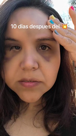 Consejos para Bajar Moretones y Hematomas Rápido
