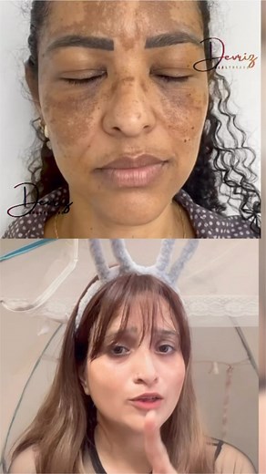 14K views · 118 reactions | Dark spot & pigmentation & Tanning!! Simple Skincare routine !! Face wash serum and more remedy !! More information WhatsApp 6206588443 !! Follow More Video ✅ #instagram #trendingreels #skinhealth #beautytips #pigmentation #melasma #FacebookPage #facebookviral | Amy Aliya Devriz | Facebook