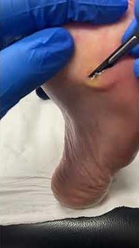 Watch this significant corn removal transformation by our expert podiatrist #FootCare #PodiatryMagic