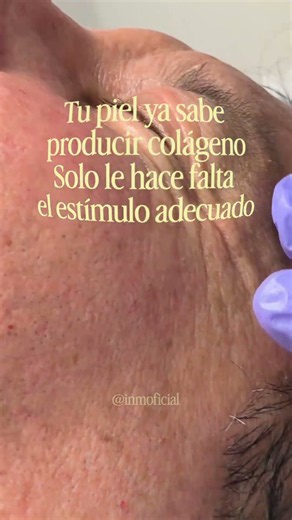 Dermapen: cómo estimula el colágeno y mejora la piel | INM Madrid