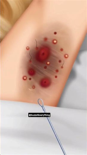 Deep wound cleaning ASMR video #asmr #animation #asmrearcleaning #satisfying #asmrvideos #cleaning