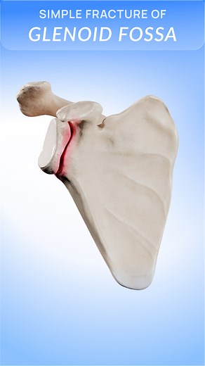 11K views · 77 reactions | How does a simple glenoid fossa fracture affect your shoulder? Explained in 3D  Explore shoulder injuries and their healing process in 3D with VOKA 3D Anatomy & Pathology! #glenoidfracture #shoulderinjury #orthopedics #shoulderrehabilitation #3D #3Danimation #3Dvisualization #3Dmedicalvisualization #3Dmedicalanimation #3danatomy #medstudents #medicaleducation #anatomy #pathology #3danatomy #digitallearning #humanbody | VOKA 3D Anatomy & Pathology | Facebook